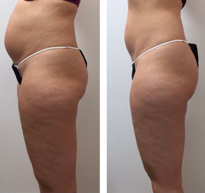 Comparativa del antes y el después de la primera fase de Laysa Detox.
