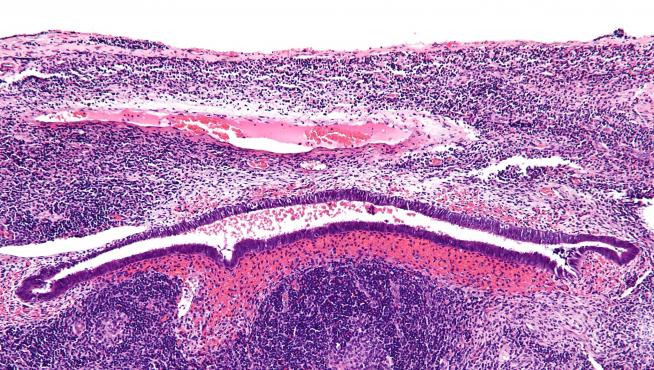 Micrografía de aumento de endometriosis en un ganglio linfático.