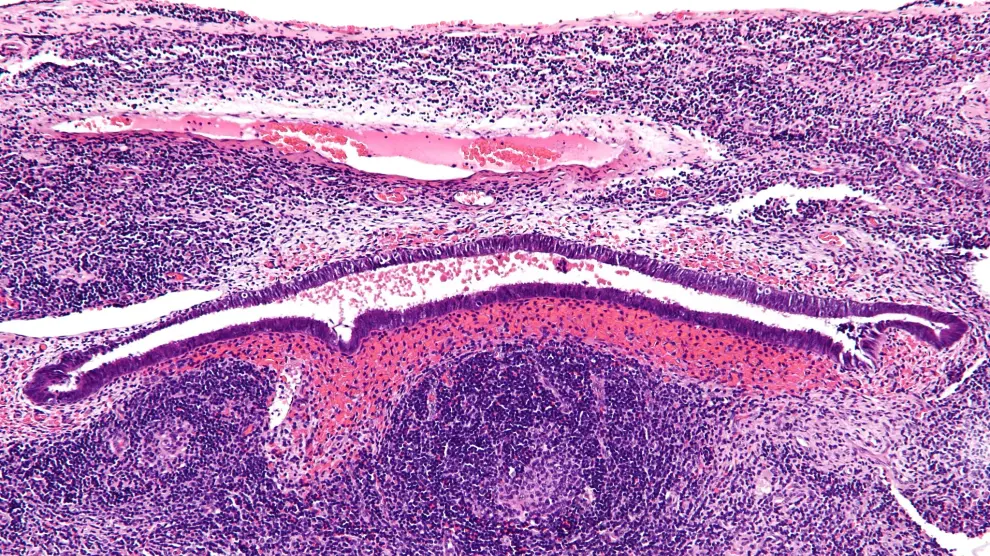 Micrografía de aumento de endometriosis en un ganglio linfático.