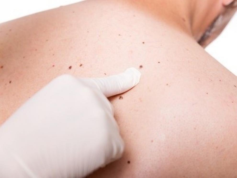 Baja la mortalidad por melanoma en menores de 65 años y sube en los mayores