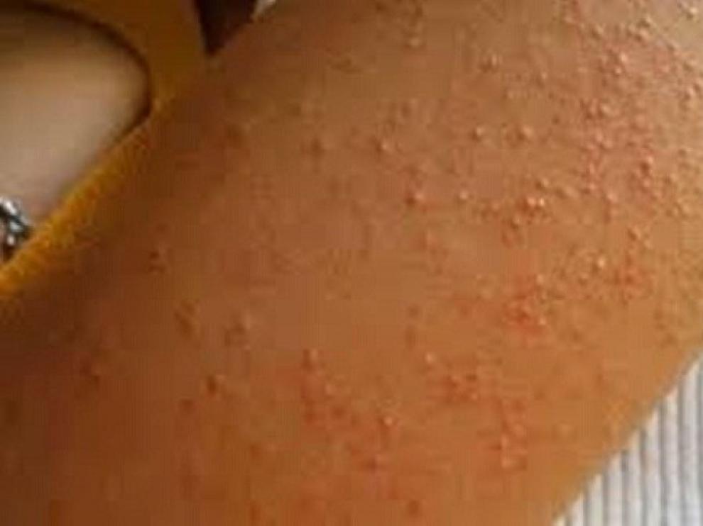 Los brotes de sarna, con 207 episodios, fueron los más frecuentes en 2019 en Aragón