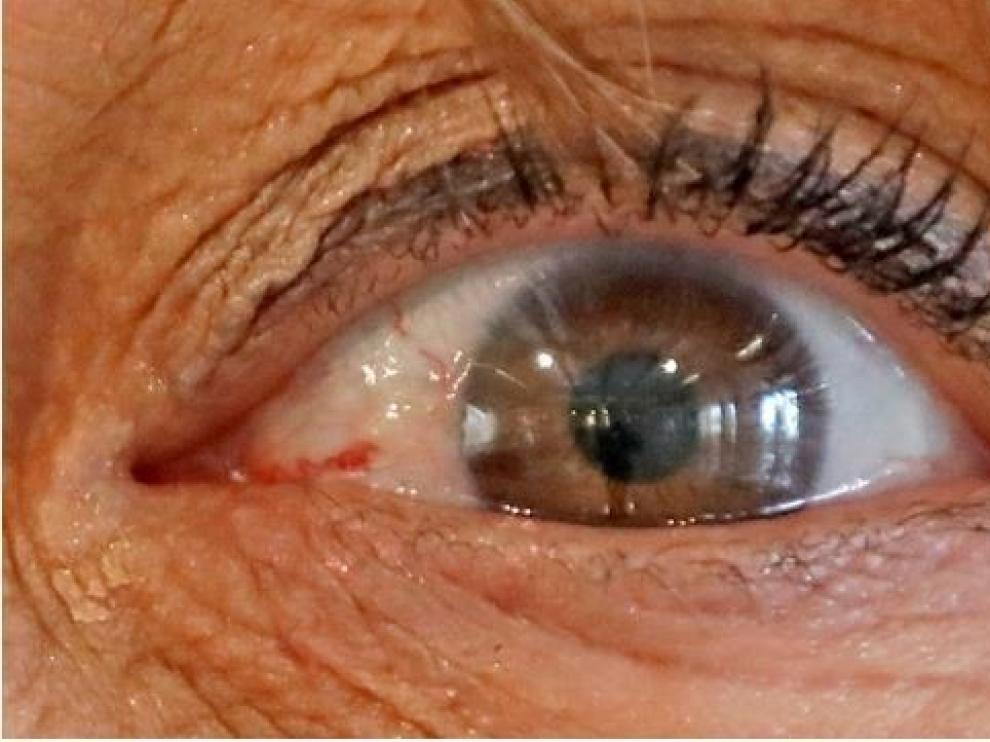 Avance en el diagnóstico precoz del alzhéimer a través de la retina