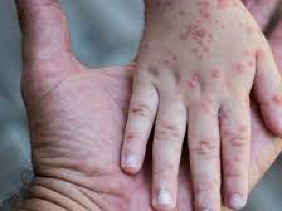 La viruela del mono produce numerosas pústulas y marcas en la piel.